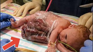 Baby born with organs outside the body [upl. by Lorenza901]