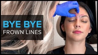 Why We Use BOTOX For Frown Lines [upl. by Enilraep]