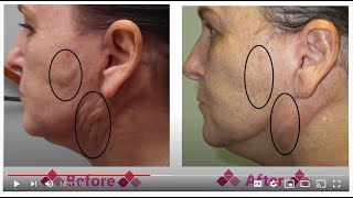 Fibrosis to Face After a Face Lift  Aspen Facelift Treatment for Lumpy Knots [upl. by Selie]