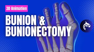 Bunion and Bunionectomy with Osteotomy  3D Animation [upl. by Enaoj]