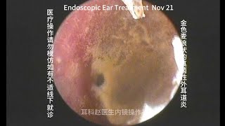 Ear wax removal Golden earwax fungus dry sheet cleaning 20241121 [upl. by Eerrehs]