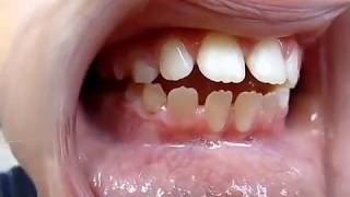 Tongue Thrust Video Myofunctional Therapist [upl. by Adiari]