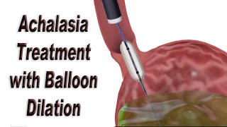 Achalasia Treatment with Endoscopic Balloon Dilation [upl. by Monjan842]