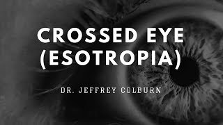 CrossedEye Esotropia  Dr Jeffrey Colburn [upl. by Khudari63]