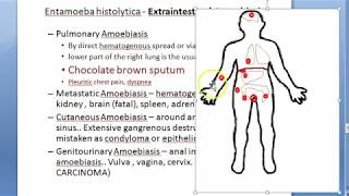 Parasitology 026 e Extraintestinal Amoebiasis entamoeba histolytica hepatic liver abscess anchovy [upl. by Angelia]