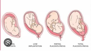 How to manage antepartum haemorrhage🚨😷drsaminakhurshidgynaecolog4661 [upl. by Rehpitsirhc]