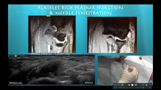 Ultrasound guided Platelet Rich Plasma Injection for Elbow Lateral Epicondylitis [upl. by Andrea]