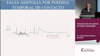 Interpretación de registros de Holter implantables [upl. by Marilyn]