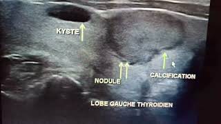 Échographie thyroïdienne nodule TIRADS 4b et kyste TIRADS 2 [upl. by Ahusoj]