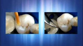 EQUIA Restoring the Posterior Dentition Live Video [upl. by Rasecoiluj196]