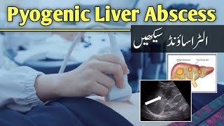 Pyogenic Liver Abscess in Ultrasound by Dr Ali Waqar [upl. by Yenaled]