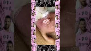 Skincare Blackheads Removal 2024 19 tweezers skincare blackheads blackheads 角栓 角栓 [upl. by Auqkinahs966]