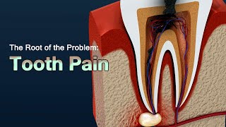 Causes of Severe Toothache and How to Relieve the Pain [upl. by Savell]