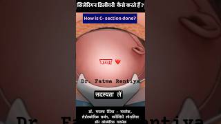 सिजेरियन कैसे किया जाता है   ऑपरेशन से बच्चे की डिलीवरी कैसे करते हैं   How is Csection done [upl. by Ebby899]