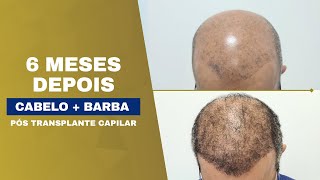 Ainda tem cabelo pra crescer  Calvície grau VI drpaulolu implantecapilar transplantecapilar [upl. by Nave]