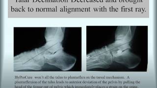 HyProCure® Before amp After TaloTarsal Stabilization [upl. by Narret]