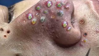 Big Cystic Acne Blackheads Extraction Blackheads amp Milia Whiteheads Removal Pimple Popping  2762 [upl. by Bax]