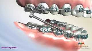 Different Types of Forsus  Orthodontic Appliance [upl. by Victorine]