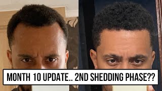 Month 10 Update Afro FUE Hair Transplant Turkey Cosmedica 2nd Shedding Phase [upl. by Reiche]