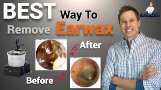 The BEST Way to Professionally Remove Earwax  Earigator Cerumen Irrigation [upl. by Merce]