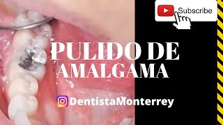 AMALGAMA Dental 👅 PULIDO [upl. by Eseenaj]