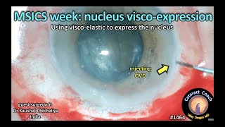 CataractCoach 1464 MSICS nucleus visco expression [upl. by Reffotsirk]