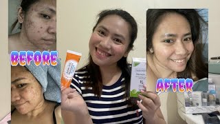 How I cleared my skin for 3 months epiduo gel forte Azelaic acid [upl. by Flam]