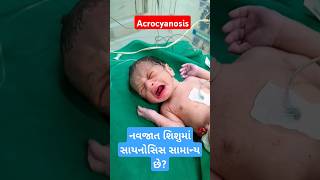 Acrocyanosis નવજાત શિશુમાં સાયનોસિસ સામાન્ય છેshorts trending cutebaby youtubeshorts hospital [upl. by Animaj]