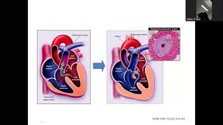 Eisenmenger Syndrome by Dr Abdullah Shahriar sir [upl. by Anaeirb332]