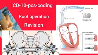 IP DRG trainingICD10PCS codingRoot operation Revision [upl. by Nirok]