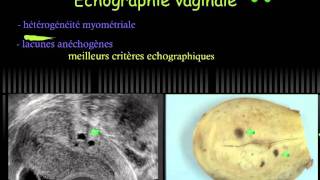 adénomyose cours 2011 hysteroscopieechographie 3D 4DHysteroscopic adenomyosis Dr Zemmouri najib [upl. by Eisdnil]