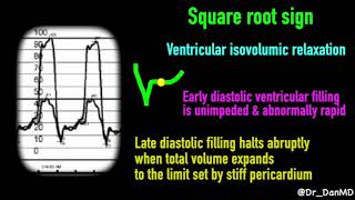 Constrictive pericarditis [upl. by Noirad160]