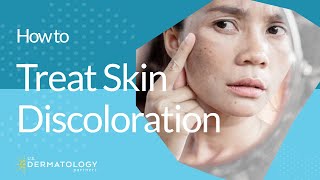 How to Treat Skin Discoloration [upl. by Brelje47]