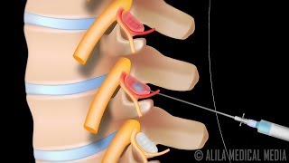 Lumbar Facet Joint Injection Procedure Animation [upl. by Ayihsa74]