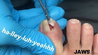 REMOVING A LARGE INGROWN TOENAIL [upl. by Aicirtal]