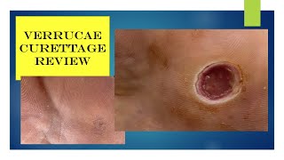 Video  verrucae curettage review [upl. by Ava]