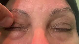 Apraxia of eyelid opening and Blepharospasm [upl. by Irmgard]