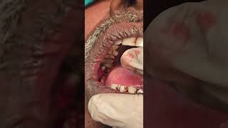 Verrucous carcinoma buccal mucosa excision unedited cautery laser  Dr Hitesh Patel [upl. by Aikemahs]