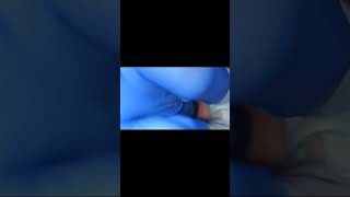 PMMA bridge for upper premolar molar implants fixing video [upl. by Ellison179]