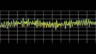 Hemangioma  Rife Frequencies [upl. by Ennaira]