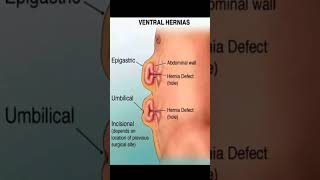 Ventral hernias motivation subscribe subscribe [upl. by Aned344]