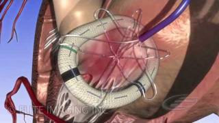 Mitral Heart Valve Ring  Medical amp Scientific Video Production [upl. by Hughes]