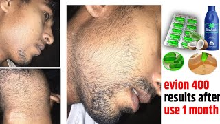 vitamin e capsules for beard growth  evion 400 beard growth  vitamin e for beard growth [upl. by Harrie]