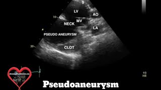 Pseudoaneurysm Echocardiography [upl. by Banky]