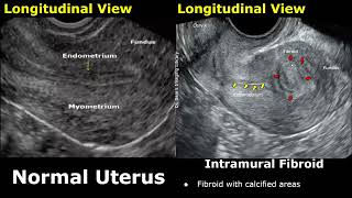 Uterus Ultrasound Normal Vs Intramural Fibroid Images  Uterine Leiomyomas USG Cases [upl. by Annaek]