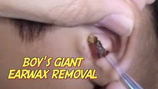 Boys Giant Earwax Removal [upl. by Scrope]