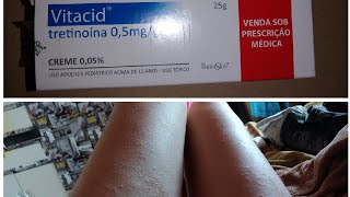 MINHA EXPERIÊNCIA COM O VITACID tretinoína NA QUERATOSE PILAR COM FOTOS [upl. by Nomyt83]