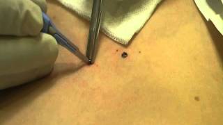 Microdermal Dermal Anchor Removal at MediZen Cosmetic Clinic Birmingham UK [upl. by Oleic304]