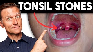 Tonsil Stones Removing the Deeper Cause [upl. by Hgielsel890]