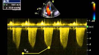 14 Estimating right ventricular  pulmonary artery systolic pressure from TR jet [upl. by Weitman]